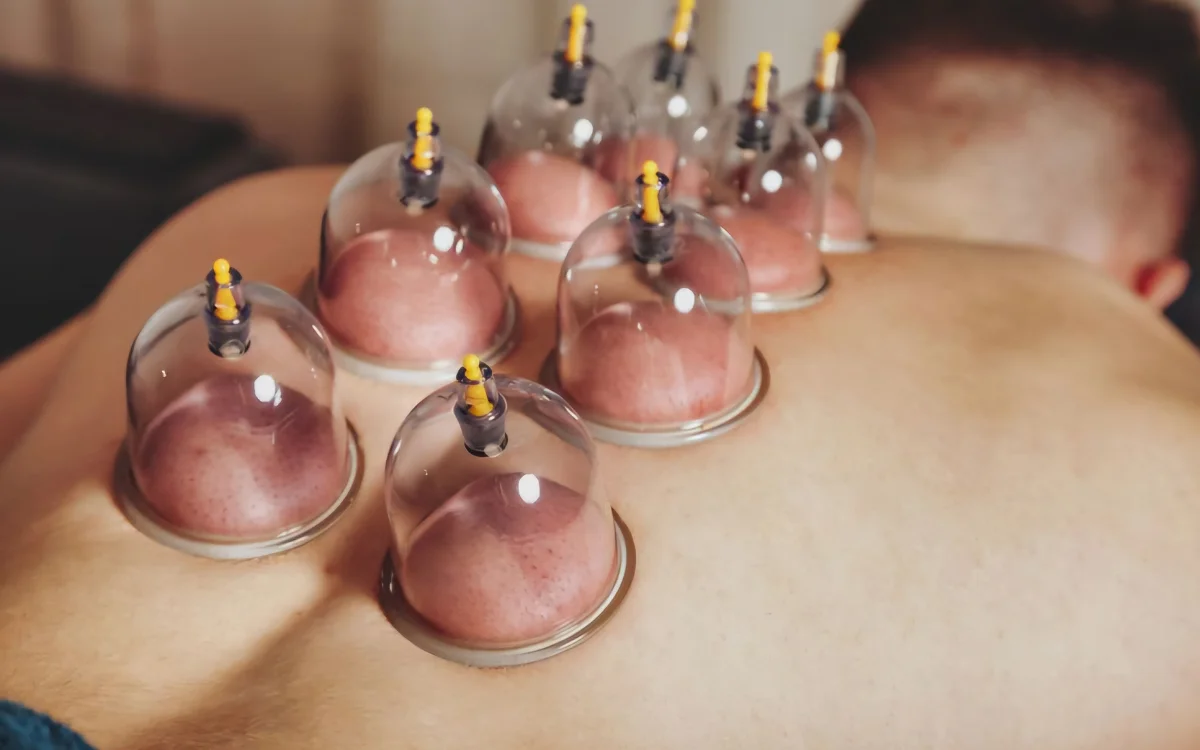Ventosas o cupping